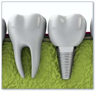 How-Dental-Implants-Works