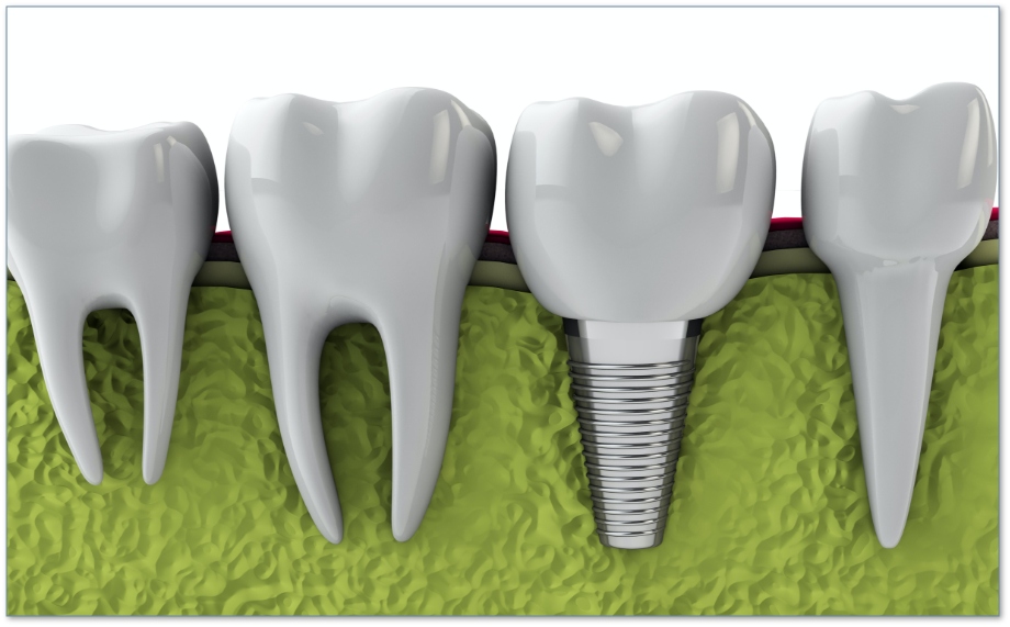 how-dental-implants-work