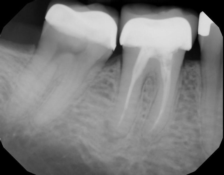 Root Canal Awareness Week Stone Ridge Dental