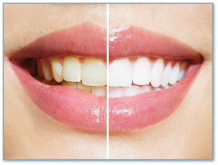 whitening-offer